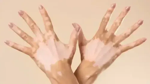 How to Prevent Vitiligo?